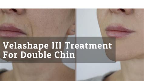 11 Velashape doctors & clinics in Cincinnati, OH .